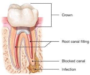 gain access to the root canal filling materia