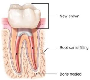 have a new crown or other restoration placed