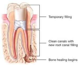 seal the canals and place a temporary filling in the tooth