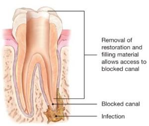 clean the canals and carefully examine the inside of your tooth