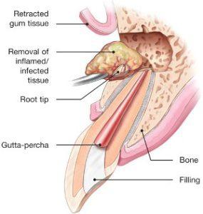 endodontic microsurgery apicoectomy