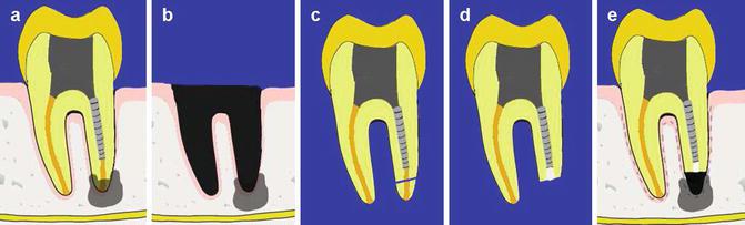 intentional replantation at Pathways Endodontics