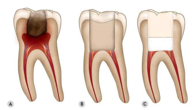 pulpotomy at Pathways Endodontics