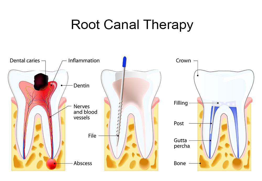 Root canal therapy in Morgan Hill